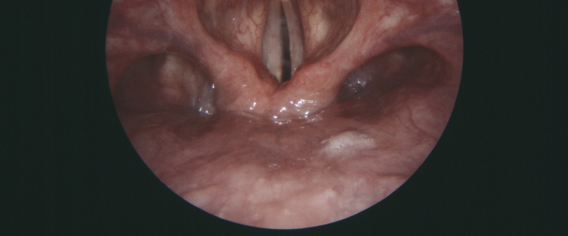 Why vocal cord paralysis?